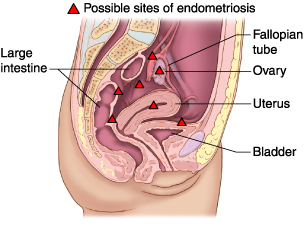 Image courtesy of mdguidelines.com/endometriosis
