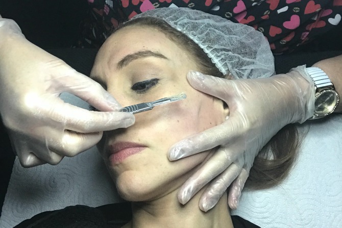 Dermaplaning: the results are in