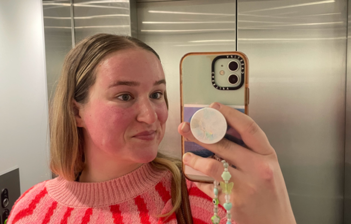 No, it’s not sunburn. We road tested a vampire facial.