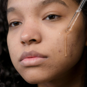 Supporting your teen through breakouts: A skin specialist’s guide (from someone who’s been there)
